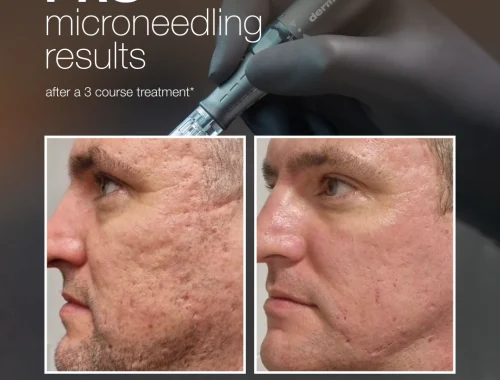 A microneedling device is used in a close-up treatment on facial skin.