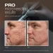 A microneedling device is used in a close-up treatment on facial skin.
