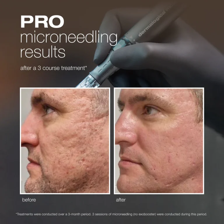 A microneedling device is used in a close-up treatment on facial skin.