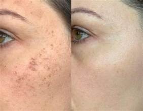 Close-up view of skin undergoing a resurfacing treatment.