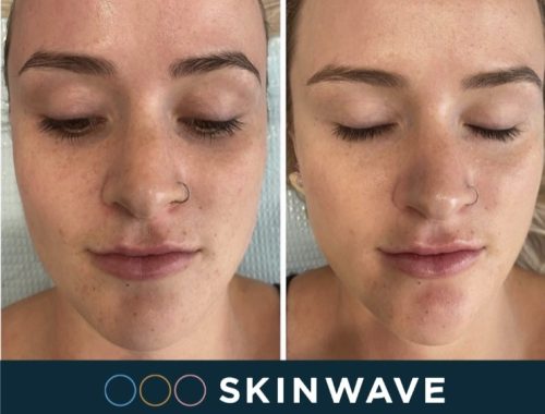 A client receives a SkinWave hydrafacial treatment for refreshed, hydrated skin.