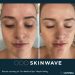 A client receives a SkinWave hydrafacial treatment for refreshed, hydrated skin.